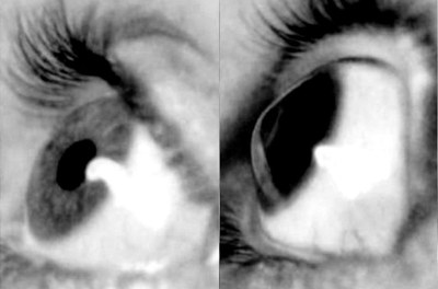 Imagem comparativa de uma córnea normal e uma com ceratocone. Foto: Arquivo pessoal do pesquisador